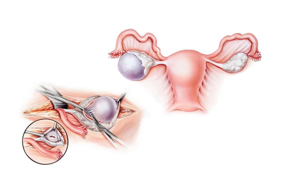 Cistektomia Vaginale