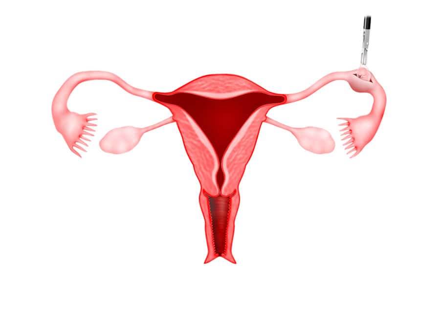 Trajtim kirurgjikal transvaginal i gravidancës tubare