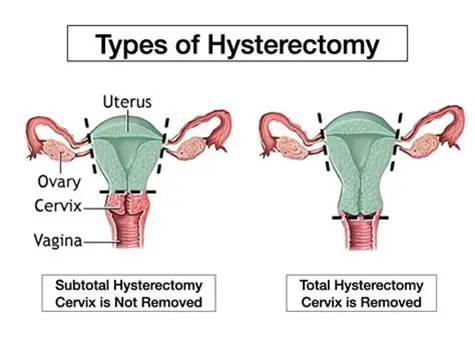 Diagram showing types of hysterectomy procedures in gynecology.