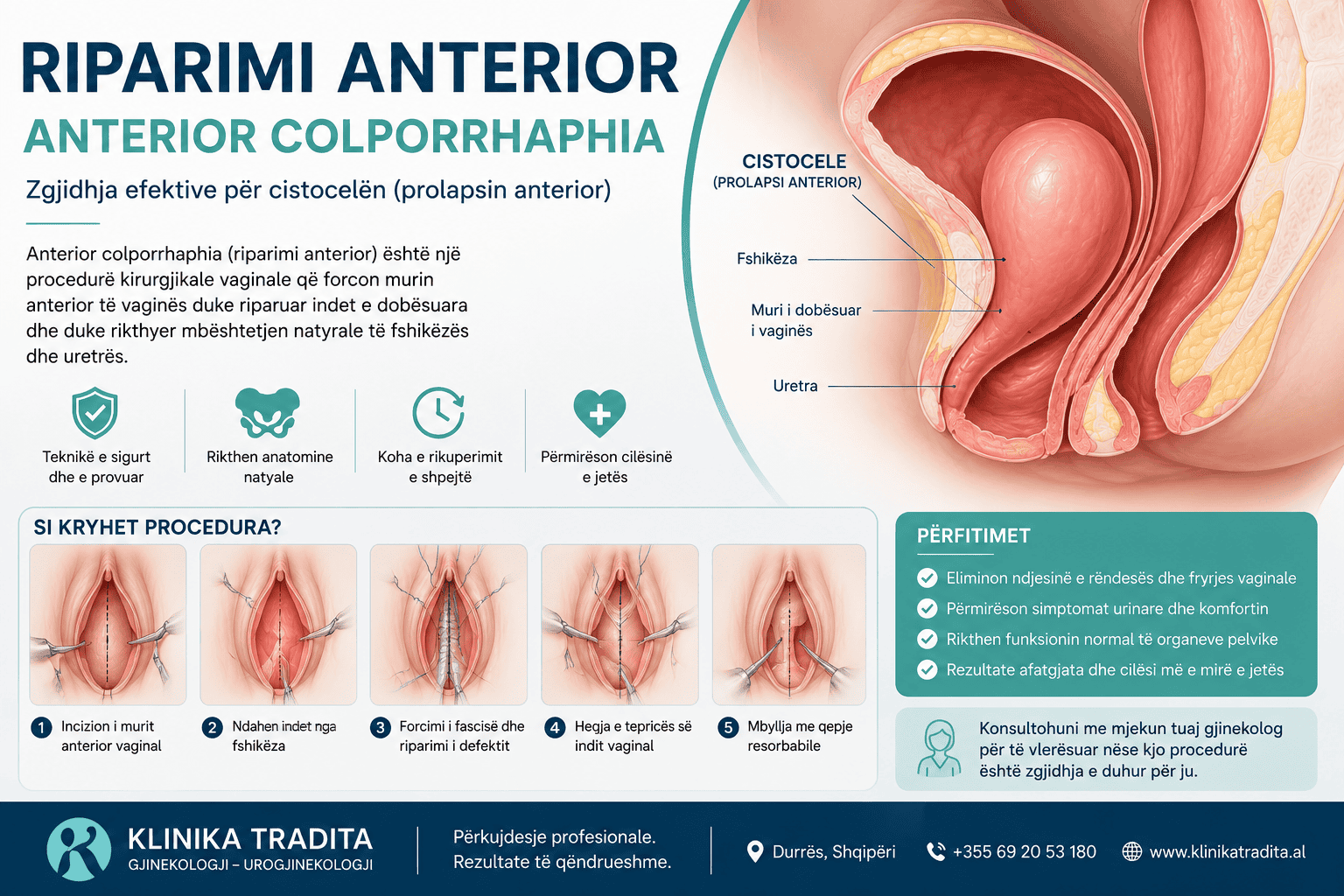 Riparimi anterior